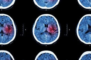 中风患者的脑部CT扫描图