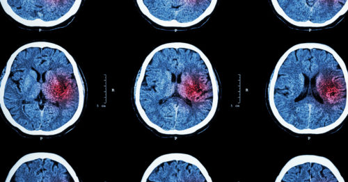 Can COVID-19 cause a stroke?