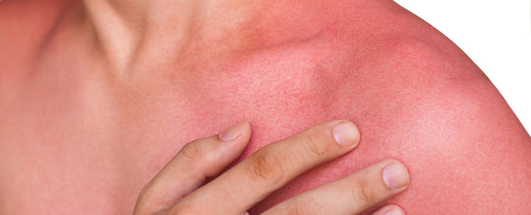 Man with sun rash on chest and arms.