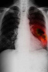 肺癌的x线检查